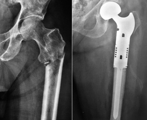 Fratura Patológica do Fêmur por Metástase Óssea. Realizada Ressecção da Lesão e uso de Endoprótese Modular STAGE (Baumer S.A.)