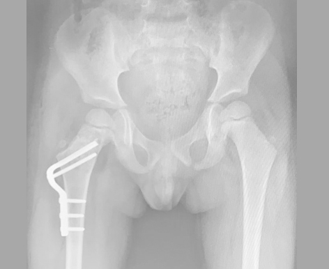 Cisto Ósseo Simples no Quadril de Criança. Alto Risco de Fratura. Realizada Drenagem do Cisto, Enxertia Óssea com Orthogen (Baumer S.A) e Fixação com Placa