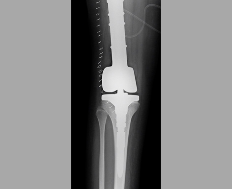 Endoprótese MUTARS (Implantcast) para Tumor Ósseo de Fêmur (Joelho)