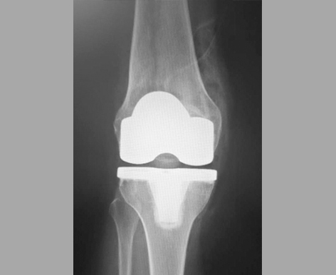 Artroplastia Total de Joelho (ATJ) para Gonartrose. Implante Persona, Zimmer- Biomet