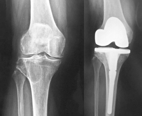 Artroplastia de Joelho em Portadora de Gonartrose e Cisto Gangliônico Ósseo na Tíbia. Implante Zimmer Biomet