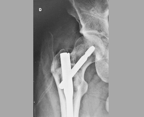 Fixação Preventiva de Cisto Ósseo no Quadril de Adulto Associado à Enxertia com Orthogen (Baumer S.A.)